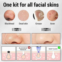 Electric Blackhead Remover — Deep Pore Vacuum Cleanser | Clearer, Smoother Skin